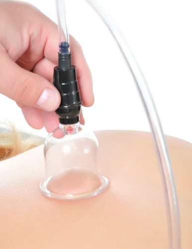 Beginner's 6pc. Cupping Set Clear/ Black